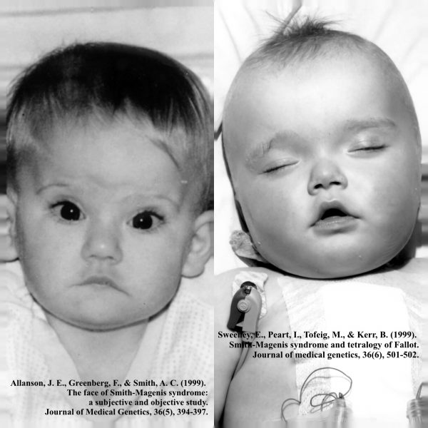 5 INDICIOS PARA SOSPECHAR QUE TU HIJO TIENE SMITH MAGENIS